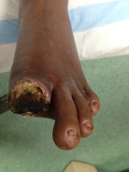 This is called desperation:  to amputate your own toe takes some serious Cahones, and a lack of any other options.